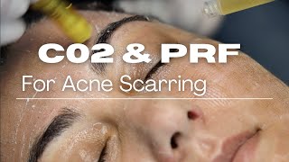 CO2 Laser and PRF Skincare Treatment Process [upl. by Nakada]