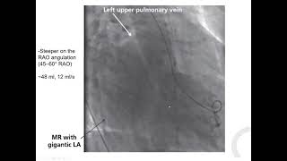 Catheter techniques 4 LV catheterization  Elias Hanna Univ Iowa [upl. by Nyliuqcaj280]