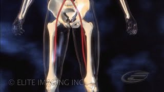 Femoral Clot Removal  Medical amp Scientific Video Production [upl. by Oremor]