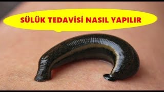 Sülük Tedavisi Nasıl Yapılır ve Faydaları Varikosel Tedavisi [upl. by Bran]