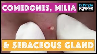 A Dr Pimple Popper Medley Heavy on the Blackheads [upl. by Jayme]