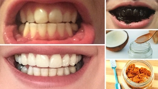 DIY 10 Home Remedies To Whiten Teeth [upl. by Oys566]