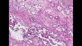 Histopathology TestisEmbryonal carcinoma [upl. by Oetam]