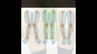 Bow Legged Treatment  Symptoms and Causes  Diagnosis  Prevention health [upl. by Siravaj]