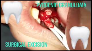 Conservative Approach of Oral pyogenic granuloma surgical excision benign exophytic and vascular [upl. by Aicirt]