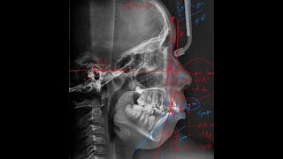 14 Proclination VS Protrusion in Cephalometric analysis Cephalometric analysis [upl. by Elrahc]