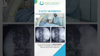 Facet joint Arthritis is a Common Cause Of Back Pain in Elderly [upl. by Leidag]