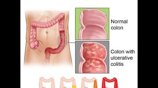 Ulcerative Colitis [upl. by Chu]