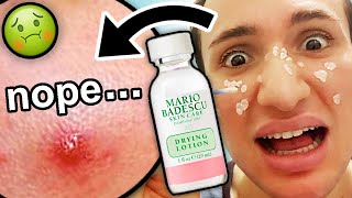 I tried Mario Badescu DRYING LOTION for ONE WEEK I was shocked honey [upl. by Chor]