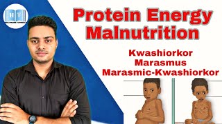 Protein Energy Malnutrition  Kwashiorkor Vs Marasmus [upl. by Vigor181]