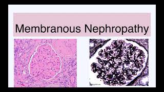 Membranous nephropathy [upl. by Kinelski]