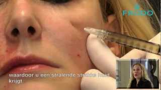 PRP plasma behandeling Vampire facelift met Platelet Rich Plasma [upl. by Eillom]