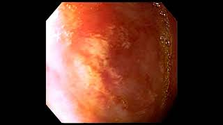 Stomal ulcer with gastritis [upl. by Aspasia422]