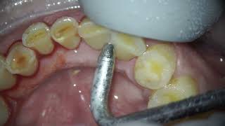 Warning How Teeth Tar and Plaque Ruin Your Smile dentist teethcleaning teeth dental cavity [upl. by Tibbetts623]