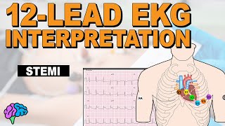 Recognize ST Elevation Myocardial Infarction STEMI on 12lead EKG [upl. by Ainessey780]