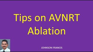 Tips on AVNRT Ablation [upl. by Leile681]