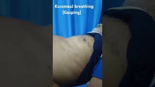 Kussmaul Breathing [upl. by Stent]