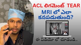 ACL Tear  How to see on MRI Knee ligament tear  Knee instability  Dr Ramprasad Kancherla [upl. by Ferdinanda461]