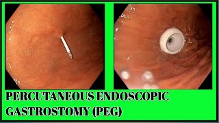 Percutaneous Endoscopic Gastrostomy PEG Tube Deployment  SQUARE HOSPITALS LTD Dhaka BDENDOSCOPY [upl. by Darryl]