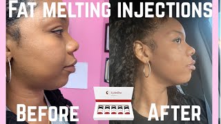 Kabelline Vlog Korean Kybella Fat Melting Injections Double Chin Be Gone Face amp Body Contouring [upl. by Ruffi]