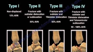 Talus Fracture Types  Everything You Need To Know  Dr Nabil Ebraheim [upl. by Leipzig586]