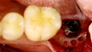 Safe implantation using Dentium short implant [upl. by Sashenka]