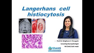 Langerhans cell histiocytosis [upl. by Uno272]