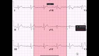 PWAVE PRI MEASUREMENTS [upl. by Doreg901]