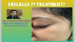 What is frecklestreatmentpreventionbrown spots on face चेहरे पर झाइयाँ या तिल [upl. by Veleda]