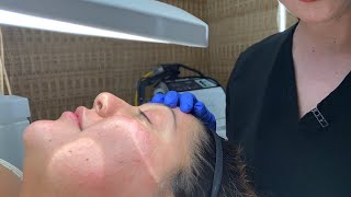 Extractions  Facial Treatment  West Hollywood CA  Dr Jason Emer [upl. by Ysdnil]