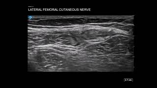 Thigh Ultrasound Lateral Femoral Cutaneous Nerve LFCN Block for Meralgia Parasthetica [upl. by Nets]