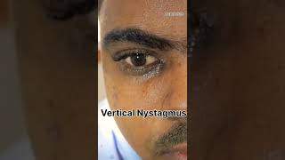 Nystagmus mbbs neet ophthalmology aiims shorts neetpg doctor eyes [upl. by Martina]