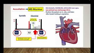 Mitral stenosis  Omar Layth  Cardiology made easy [upl. by Luehrmann341]