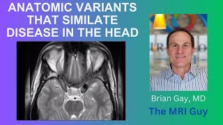 Anatomic variants in the head that simulate disease Part 1 [upl. by Ainod853]