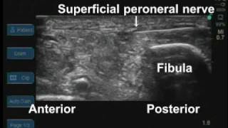 UltrasoundGuided Phenol Injection into the superficial Peroneal Nerve [upl. by Nnilsia]