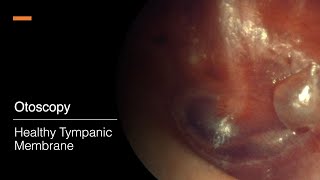 Bullous Myringitis Otoscopy [upl. by Zurn]