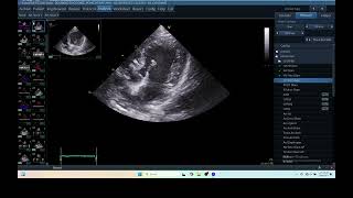 IQ 279 HEMODYNAMIC ECHOPAC ANALYSIS ECHOCARDIOGRAPHY HEPATOMA [upl. by Bringhurst]