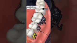 braces orthodontics braces orthodontist dental dentist shorts viralshorts [upl. by Rigby262]