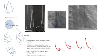 Left ventricular catheterization including AS and left ventriculography Diagrams and cases [upl. by Sig]