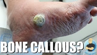 HUGE CALLOUS DUE TO COLLAPSED ARCH EXTREME CALLOUS REMOVAL [upl. by Ahsinyar865]