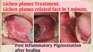 Lichen planus TreatmentLichen planus related fact in 1 minute [upl. by Yanad]