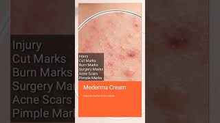 Mederma Cream For Injury Cut Marks Burn Marks Surgery Scar Scne Scar Pimple Marks [upl. by Agustin]