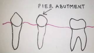 Pier Abutment in Fixed Partial Dentures [upl. by Yran533]