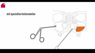 Nasennebenhöhlen OP  FESS  chronische Sinusitis [upl. by Hametaf589]