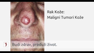 Rak Kože Maligni Tumori Kože [upl. by Aicnom]