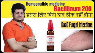 Best Homeopathic Medicine for Fungal Infection Ringworm or tinea corporis  Bacillinum 200 [upl. by Assiral]