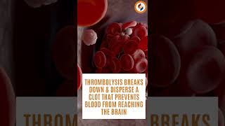 Thrombolysis Therapy Causing Breakdown of Blood Clots  Symbiosis Speciality Hospital [upl. by Kylie]