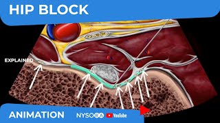 Hip Block  NYSORAs Reverse Ultrasound™ Animation [upl. by Kelcie]