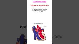 Patent ductus arteriosus [upl. by Sadick]