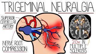 Understanding Trigeminal Neuralgia [upl. by Lane]